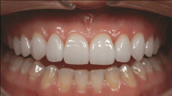 Răng sứ có tẩy trắng được không? Giải đáp băn khoăn