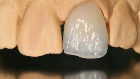 Bọc răng sứ có hết móm không? Phải điều trị bằng cách nào hiệu quả?