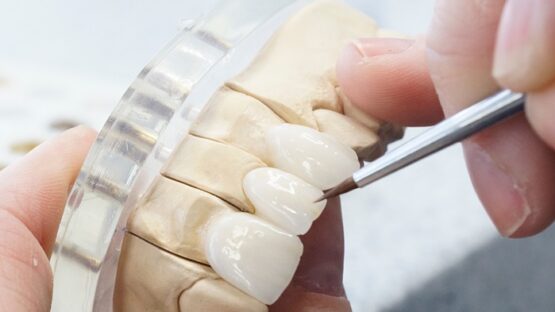 Các loại răng sứ của Đức chất lượng và thẩm mỹ tốt nhất