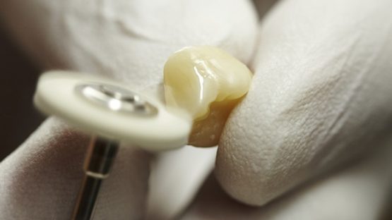 Trồng răng sứ mất bao lâu thì hoàn thành, có thể ăn nhai bình thường?