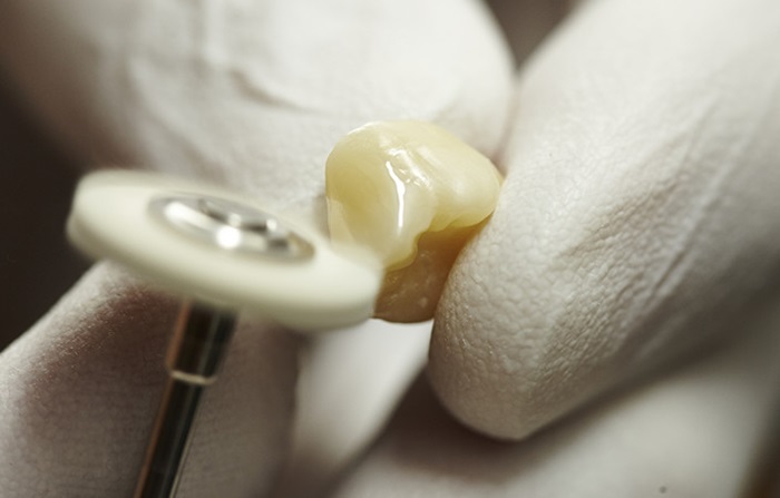 Trồng răng sứ mất bao lâu thì hoàn thành, có thể ăn nhai bình thường? 1