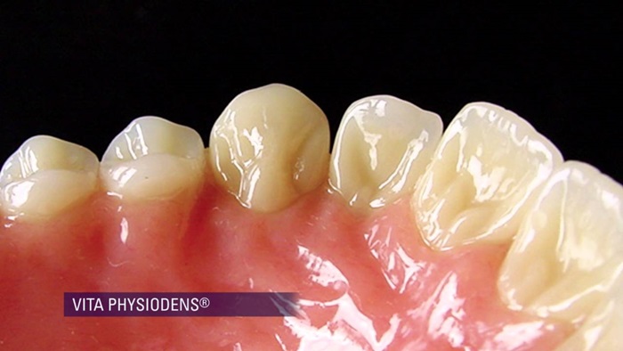 Chất liệu sứ VKM được sử dụng để làm răng sứ Vita là gì?
