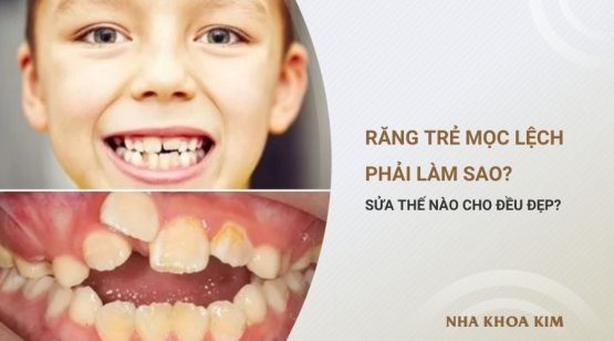 Răng trẻ mọc lệch phải làm sao? Sửa thế nào cho đều đẹp?