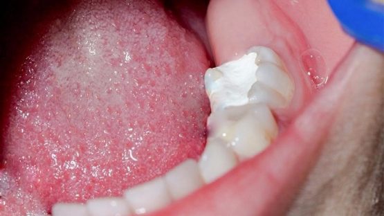 Trám lại răng – Giải pháp giúp duy trì khả năng ăn nhai và thẩm mỹ khuôn hàm