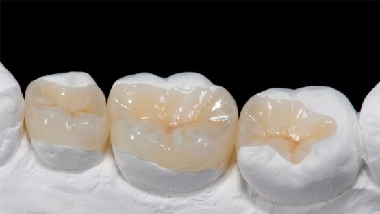 Hàn trám răng – Giải pháp phục hình răng sứt, mẻ, vỡ nhanh chóng