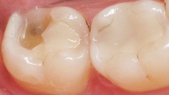 Trám lại răng khi miếng trám bị hỏng bằng cách nào hiệu quả, bền lâu?