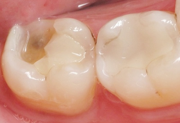  Vết trám răng bị mẻ : Tìm hiểu về nguyên nhân và cách xử lý
