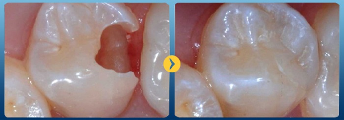 Trám lại răng khi miếng trám bị hỏng bằng cách nào hiệu quả, bền lâu? 2