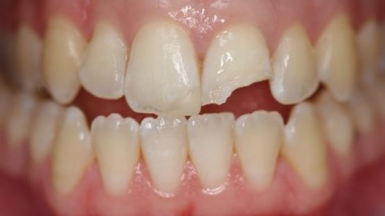 Trám răng bị gãy – Phục hình răng thẩm mỹ nhanh chóng