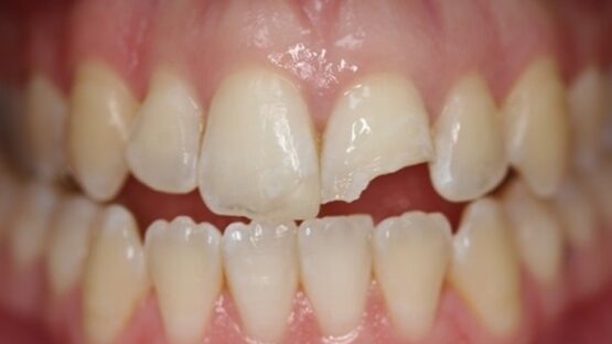 Trám răng bị gãy – Phục hình răng thẩm mỹ nhanh chóng