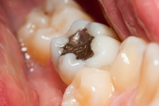 Trám răng có bền không, được bao lâu thì phải phục hình lại?