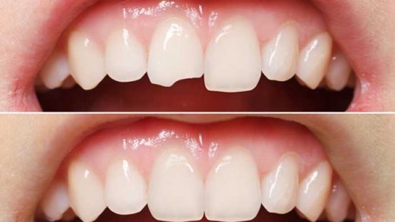 Trám răng cửa – Những lưu ý quan trọng khi phục hình cho răng