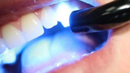 Trám răng Laser Tech – Công nghệ trám răng hiệu quả và thẩm mỹ cao