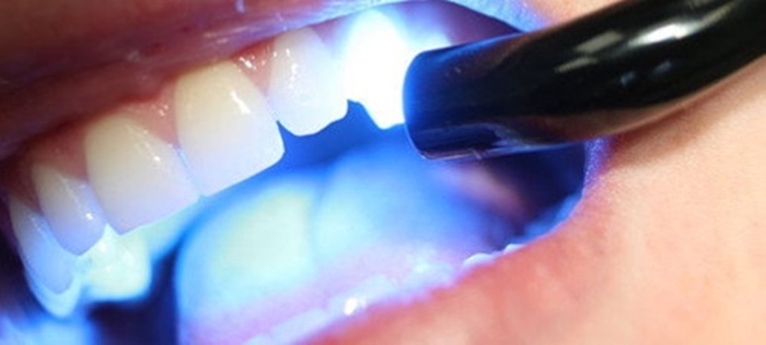 Trám răng Laser Tech – Công nghệ trám răng hiệu quả và thẩm mỹ cao 1