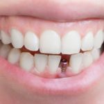 Trồng chân răng bằng phương pháp nào hiệu quả nhất? Trồng chân răng bằng phương pháp nào hiệu quả nhất?