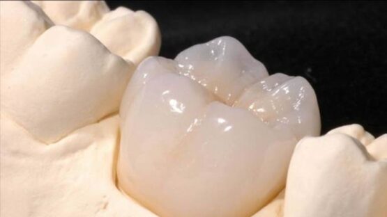 Phương pháp trồng răng số 6 đạt hiệu quả và an toàn nhất