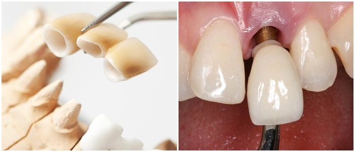 Gãy răng cửa phải làm thế nào để khắc phục hiệu quả, thẩm mỹ? 3