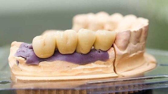 Trồng răng sứ Titan có tốt không? Chia sẻ từ chuyên gia