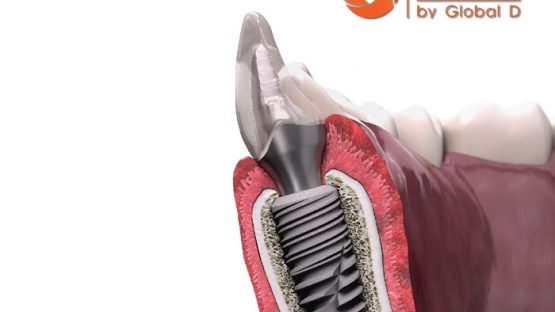 Implant Tekka là gì? Cấy ghép răng Implant Tekka có tốt không?