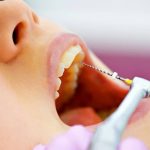 Bọc sứ lấy tủy áp dụng khi nào? Có ảnh hưởng gì không? Bọc sứ lấy tủy áp dụng khi nào? Có ảnh hưởng gì không?