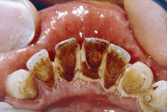 Cách làm sạch mảng bám đen trên răng “SIÊU TỐC” hiệu quả bất ngờ
