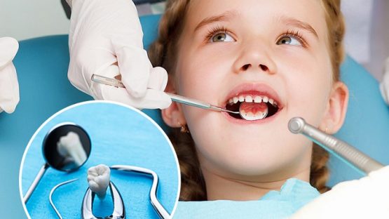 Nhổ răng trẻ em có nên tự nhổ cho trẻ tại nhà không?