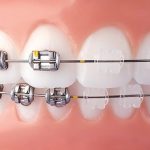 CHÍNH XÁC: Niềng răng mắc cài sứ giá bao nhiêu tiền ? CHÍNH XÁC: Niềng răng mắc cài sứ giá bao nhiêu tiền ?