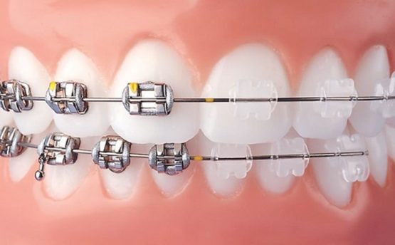 Niềng răng trả góp 0% – Cần lưu ý gì khi lựa chọn dịch vụ điều trị?