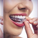 Niềng răng invisalign có hiệu quả không? Có tốt không? Niềng răng invisalign có hiệu quả không? Có tốt không?
