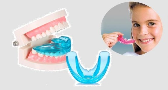 Niềng răng silicon – Chỉnh nha an toàn, thẩm mỹ cao