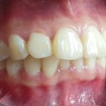 Chữa răng hô bằng cách nào hiệu quả nhất? Chữa răng hô bằng cách nào hiệu quả nhất?