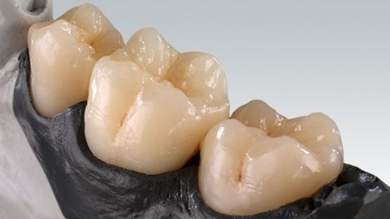 Răng sứ Zolid là gì, có tốt và bền đẹp lâu dài không?