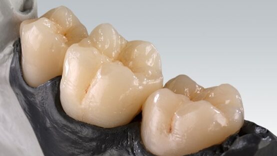 Răng sứ Zolid là gì, có tốt và bền đẹp lâu dài không?