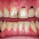 Tẩy trắng răng sâu có được không? Có an toàn và hiệu quả? Tẩy trắng răng sâu có được không? Có an toàn và hiệu quả?