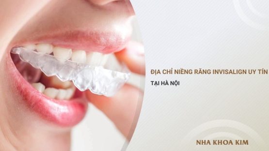 Địa chỉ niềng răng Invisalign uy tín ở Hà Nội
