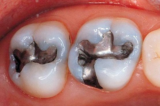 Trám răng Amalgam có tốt không? Có bền chắc lâu dài không?