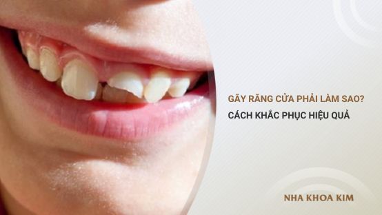 Bị gãy răng cửa phải làm sao? Cách khắc phục hiệu quả, thẩm mỹ