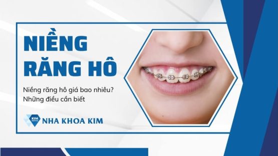 Niềng răng hô: Chi phí, thời gian và quy trình niềng