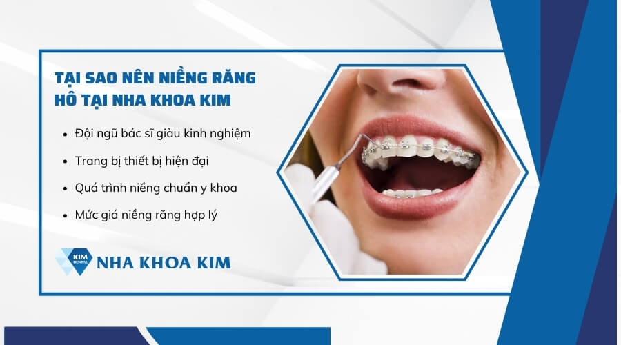 Nên niềng răng hô ở đâu an toàn, hiệu quả cao?