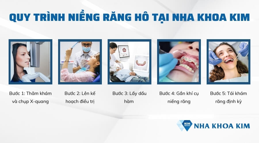 Quy trình niềng răng hô chuẩn y khoa