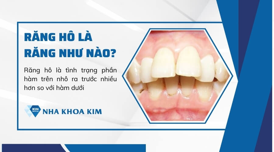 Răng hô là răng như nào?