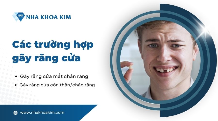 Các trường hợp gãy răng cửa