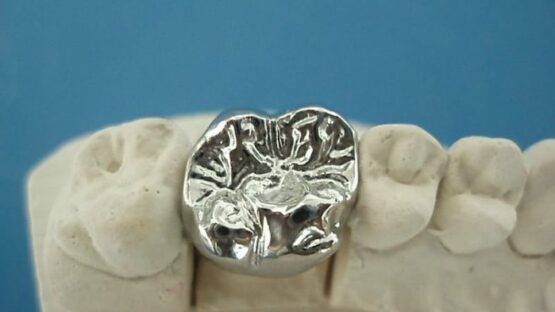 Bọc răng sứ Inox – Ưu và nhược điểm mà bạn nên biết khi lựa chọn