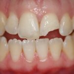 Gãy răng cửa phải làm thế nào để khắc phục hiệu quả, thẩm mỹ? Gãy răng cửa phải làm thế nào để khắc phục hiệu quả, thẩm mỹ?