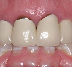 Bị hở chân răng sứ phải xử lý như thế nào nhanh và hiệu quả nhất?