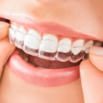 Chi phí niềng răng hô hết bao nhiêu tiền – Thông tin bạn cần biết! Chi phí niềng răng hô hết bao nhiêu tiền – Thông tin bạn cần biết!