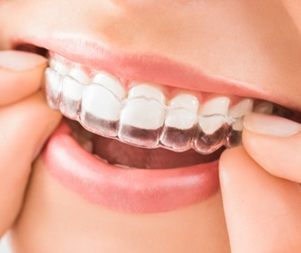 Chi phí niềng răng hô hết bao nhiêu tiền – Thông tin bạn cần biết!