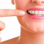 Niềng răng hô ở đâu tốt, chất lượng đảm bảo mà an toàn? Niềng răng hô ở đâu tốt, chất lượng đảm bảo mà an toàn?