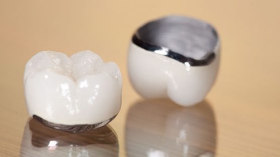 Răng sứ Chrome Cobalt là răng sứ gì, chất lượng có tốt không?