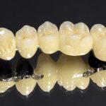 Răng sứ Coban-Crom – Giải pháp phục hình hiệu quả, đẹp, tiết kiệm Răng sứ Coban-Crom – Giải pháp phục hình hiệu quả, đẹp, tiết kiệm
